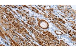 Immunohistochemistry of paraffin-embedded Human cervical cancer tissue using SHROOM2 Polyclonal Antibody at dilution 1:50 (SHROOM2 antibody)