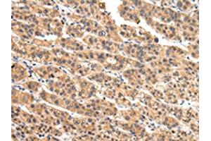 The image on the left is immunohistochemistry of paraffin-embedded Human liver cancer tissue using ABIN7128081(VIL1 Antibody) at dilution 1/30, on the right is treated with fusion protein. (Villin 1 antibody)