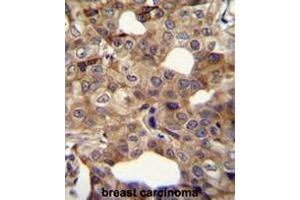 CCNI2 Antibody (Center) immunohistochemistry analysis in formalin fixed and paraffin embedded human breast carcinoma followed by peroxidase conjugation of the secondary antibody and DAB staining.
