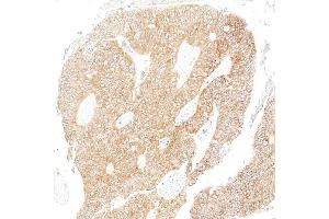 Immunohistochemistry (IHC) image for anti-Metadherin (MTDH) (AA 475-525) antibody (ABIN7795652)