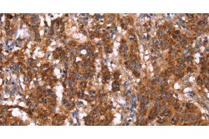 Immunohistochemistry of paraffin-embedded Human gastric cancer tissue using GAGE12I Polyclonal Antibody at dilution 1:30