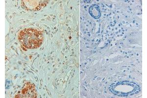 Immunohistochemistry of Rabbit anti STAT6 pY641 Antibody in human breast carcinoma pH 9(left) with negative control (right) Tissue: Human breast carcinoma (STAT6 antibody  (pTyr641))