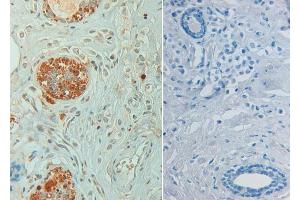 Immunohistochemistry of Rabbit anti STAT6 pY641 Antibody in human breast carcinoma pH 9(left) with negative control (right) Tissue: Human breast carcinoma (STAT6 antibody  (Internal Region, pTyr641))