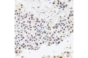 Immunohistochemistry of paraffin-embedded human lung cancer using RPP30 antibody. (RPP30 antibody)