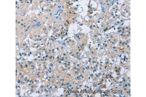 Immunohistochemistry of Human thyroid cancer using BTN2A2 Polyclonal Antibody at dilution of 1:50