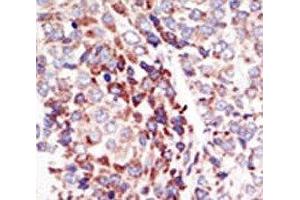 IHC analysis of FFPE human hepatocarcinoma tissue stained with the TIE2 antibody (TEK antibody  (AA 758-789))