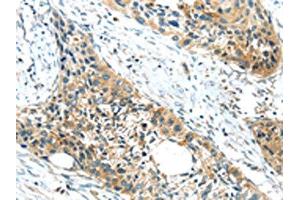 The image on the left is immunohistochemistry of paraffin-embedded Human esophagus cancer tissue using ABIN7190846(GPR15 Antibody) at dilution 1/20, on the right is treated with synthetic peptide. (GPR15 antibody)