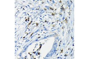 Immunohistochemistry of paraffin-embedded human colon carcinoma using NF Rabbit pAb (ABIN6130595, ABIN6144558, ABIN6144559 and ABIN6222368) at dilution of 1:200 (40x lens). (NFATC3 antibody  (AA 1-290))
