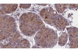 ABIN6274043 at 1/100 staining Human liver cancer tissue by IHC-P. (RhoA,B,C antibody)