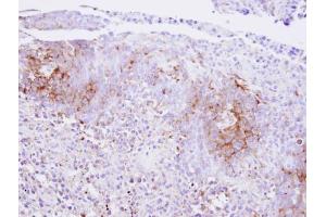 IHC-P Image Immunohistochemical analysis of paraffin-embedded SAS xenograft , using Calcium Sensing Receptor, antibody at 1:500 dilution. (CASR antibody)