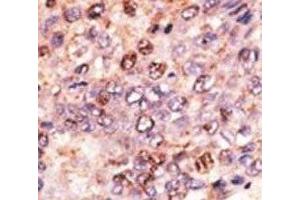 IHC analysis of FFPE human hepatocarcinoma tissue stained with the ABCB7 antibody
