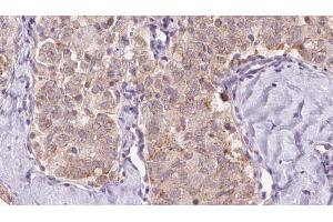 ABIN6273351 at 1/100 staining Human thyroid cancer tissue by IHC-P. (ZFYVE16 antibody  (C-Term))