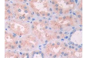 Used in DAB staining on fromalin fixed paraffin- embedded stomach cancer tissue (RNASE12 antibody  (AA 21-147))
