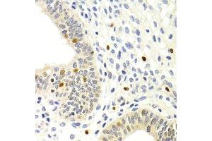 Immunohistochemistry of paraffin-embedded human uterine cancer using GEMIN2 Antibody. (SIP1 antibody)