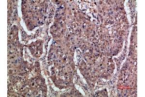 Immunohistochemical analysis of paraffin-embedded human-lung-cancer, antibody was diluted at 1:200 (IFNAR1 antibody  (AA 300-350))