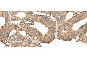 Immunohistochemistry of paraffin-embedded Human colorectal cancer tissue using AHNAK Polyclonal Antibody at dilution of 1:50(x200) (AHNAK antibody)