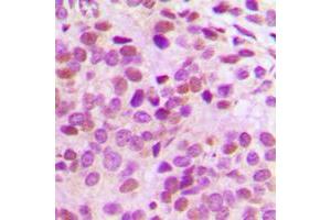 Immunohistochemical analysis of GATA3 staining in human breast cancer formalin fixed paraffin embedded tissue section. (GATA3 antibody  (Center))