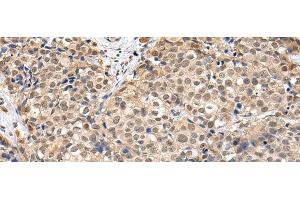 Immunohistochemistry of paraffin-embedded Human breast cancer using TBL1X Polyclonal Antibody at dilution of 1/30 (TBL1X antibody)