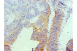 Immunohistochemical of paraffin-embedded human colon cancer using ABIN7162321 at dilution of 1:200 (Osteopontin antibody)