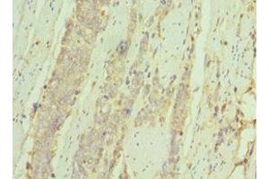 Immunohistochemistry of paraffin-embedded human colon cancer using ABIN7156926 at dilution of 1:100 (IL7R antibody  (AA 21-239))