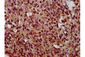 IHC image of ABIN7173123 diluted at 1:400 and staining in paraffin-embedded human glioma performed on a Leica BondTM system. (TMEM192 antibody  (AA 193-271))