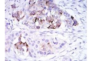 Immunohistochemical analysis of paraffin-embedded human mammary cancer tissue using SCGB2A2 monoclonal antobody, clone 3C8  with DAB staining.