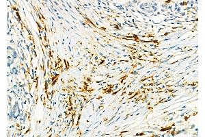ABIN6259473 and ABIN6275568 at 1/100 staining Human pancreatic cancer and adjacent nomal tissues by IHC-P. (SH3RF3 antibody  (C-Term))