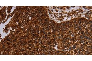 Immunohistochemistry of paraffin-embedded Human lung cancer tissue using NDUFAB1 Polyclonal Antibody at dilution 1:50