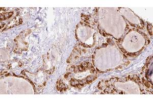 ABIN6267199 at 1/100 staining Human thyroid cancer tissue by IHC-P. (TNK1 antibody  (pTyr277))