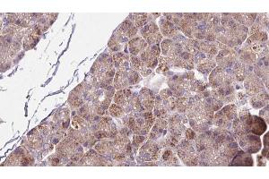 ABIN6273264 at 1/100 staining Human pancreas cancer tissue by IHC-P. (SLC39A6 antibody  (Internal Region))