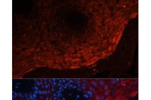 Immunofluorescence analysis of Human skin cancer using S100A8 Polyclonal Antibody at dilution of 1:100 (40x lens). (S100A8 antibody)