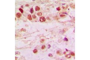 Immunohistochemical analysis of Histone Deacetylase 7 staining in human lung cancer formalin fixed paraffin embedded tissue section. (HDAC7 antibody  (C-Term))