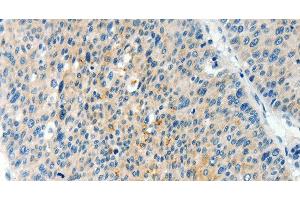 Immunohistochemistry of paraffin-embedded Human liver cancer using TPM2 Polyclonal Antibody at dilution of 1:60 (TPM2 antibody)