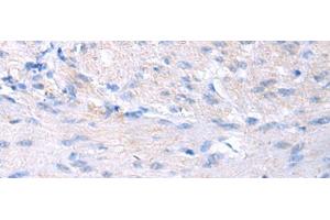 Immunohistochemistry of paraffin-embedded Human gastric cancer tissue using PROC Polyclonal Antibody at dilution of 1:80(x200) (PROC antibody)