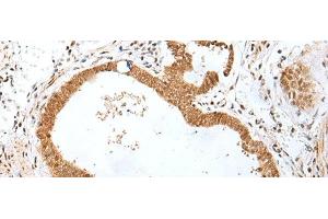 Immunohistochemistry of paraffin-embedded Human gastric cancer tissue using PEG3 Polyclonal Antibody at dilution of 1:45(x200) (PEG3 antibody)