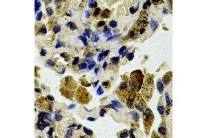 Immunohistochemical analysis of Caspase 3 p12 staining in human lung cancer formalin fixed paraffin embedded tissue section. (Caspase 3 p12 antibody)