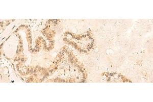 Immunohistochemistry of paraffin-embedded Human thyroid cancer tissue using ZNF85 Polyclonal Antibody at dilution of 1:35(x200) (ZNF85 antibody)