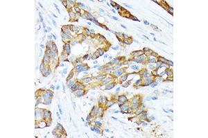 Immunohistochemistry of paraffin-embedded human esophageal cancer using STIP1 Rabbit mAb (ABIN1512566, ABIN3020619, ABIN3020620 and ABIN7101303) at dilution of 1:100 (40x lens). (STIP1 antibody)