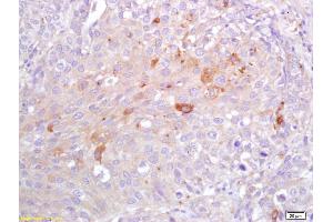 Formalin-fixed and paraffin embedded human lung carcinoma labeled with Rabbit Anti CRP Polyclonal Antibody, Unconjugated (ABIN725570) at 1:200 followed by conjugation to the secondary antibody and DAB staining