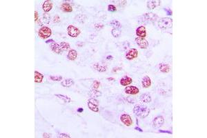 Immunohistochemical analysis of Cyclin E1 staining in human lung cancer formalin fixed paraffin embedded tissue section. (Cyclin E1 antibody  (Center))