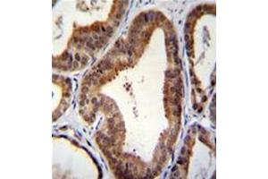 Formalin fixed, paraffin embedded human prostate carcinoma stained with SHQ1 Antibody (N-term) followed by peroxidase conjugation of the secondary antibody and DAB staining. (SHQ1 antibody  (N-Term))