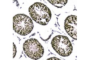 IHC testing of FFPE human breast cancer tissue with UBA2 antibody at 1ug/ml. (UBA2 antibody)