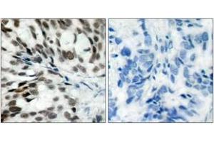 Immunohistochemistry analysis of paraffin-embedded human breast carcinoma tissue, using Retinoblastoma (Ab-780) Antibody. (Retinoblastoma Protein (Rb) antibody  (AA 751-800))