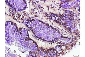 Paraformaldehyde-fixed, paraffin embedded human colon cancer, Antigen retrieval by boiling in sodium citrate buffer (pH6. (ATG16L1 antibody  (AA 501-607))