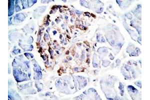 Human pancreas cancer tissue was stained by Rabbit Anti-GLP-1(7-36) -NH2 Antibody (GLP-1 antibody  (amidated))