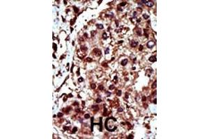 Formalin-fixed and paraffin-embedded human cancer tissue reacted with the primary antibody, which was peroxidase-conjugated to the secondary antibody, followed by AEC staining. (DGKI antibody  (C-Term))