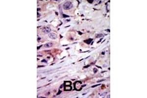 Formalin-fixed and paraffin-embedded human cancer tissue reacted with the primary antibody, which was peroxidase-conjugated to the secondary antibody, followed by AEC staining. (ALK antibody  (C-Term))