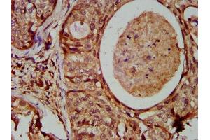 IHC image of ABIN7156667 diluted at 1:600 and staining in paraffin-embedded human cervical cancer performed on a Leica BondTM system. (IFIT2 antibody  (AA 130-265))