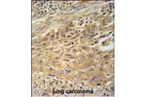 CNNM4 Antibody (Center) (ABIN651611 and ABIN2840324) immunohistochemistry analysis in formalin fixed and paraffin embedded human lung carcinoma followed by peroxidase conjugation of the secondary antibody and DAB staining.
