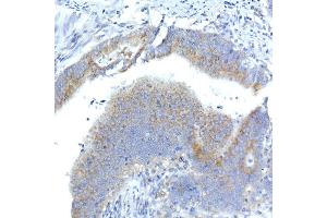 Immunohistochemistry of paraffin-embedded human colon carcinoma using Syntaxin 16 Rabbit mAb (ABIN7270681) at dilution of 1:50 (40x lens). (Syntaxin 16 antibody)
